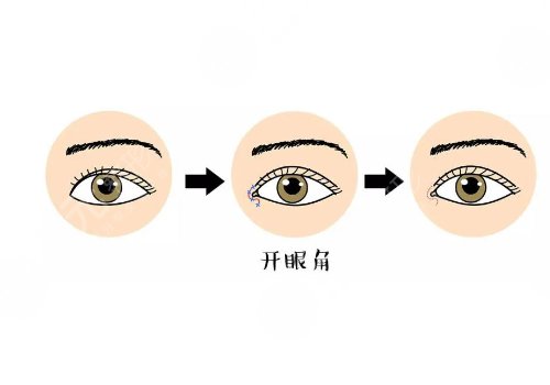 開眼角疼不疼?