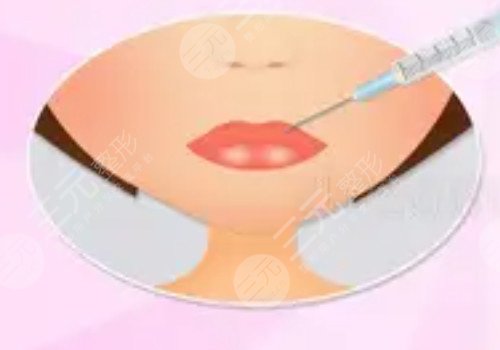 厚嘴唇怎么變??？