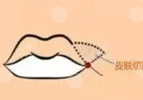 厚嘴唇怎么變薄？