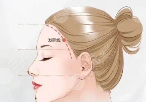 發(fā)際線移植能保持多久？