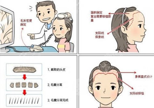 發(fā)際線移植能保持多久？