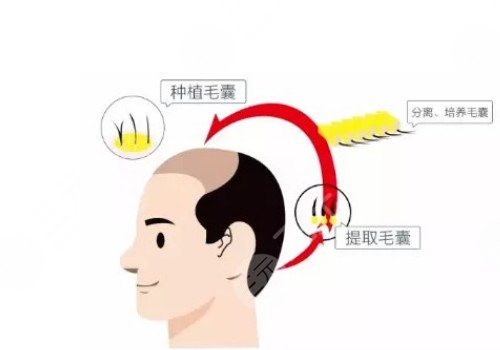 發(fā)際線移植能保持多久？