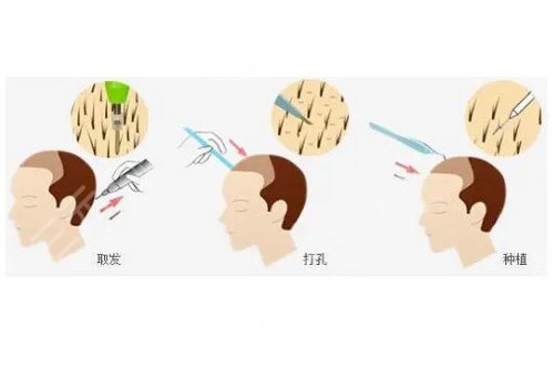 發(fā)際線移植能保持多久？