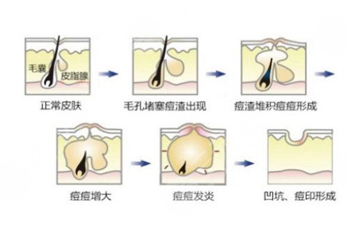 臉上長(zhǎng)痘印如何消除?