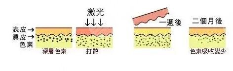 激光美白有副作用嗎?