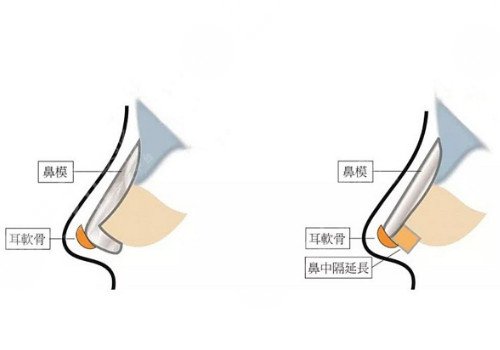 自體軟骨隆鼻多少錢？