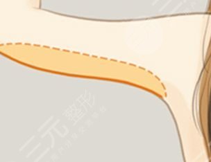 手臂吸脂