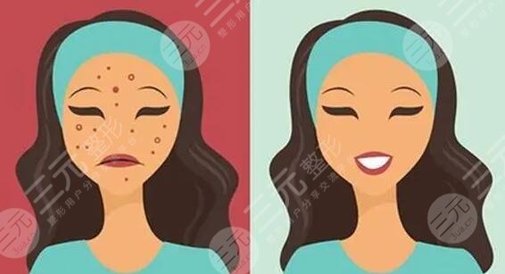 　　臉上的痘坑怎么去掉?隨著年齡的增長，不少人臉上都出現(xiàn)了青春痘或者是長痘的情況，這些多數(shù)是由內(nèi)分泌失調(diào)和皮膚油脂平衡失調(diào)造成的，首先在發(fā)現(xiàn)自己長痘之后，就需要通過正規(guī)的祛痘手術(shù)去除痘痘才行，如果是不正規(guī)的方法就容易造成痘坑、痘印，對于小伙伴們來說，痘坑痘印比痘痘更讓人難受，目前國內(nèi)可以去痘坑的方法有很多，都是國內(nèi)祛痘坑成功的小伙伴們選擇的技術(shù)手段，下面就有小編一一來為大家做一個介紹!  　　1、臉上的痘坑怎么去掉更有?  　　(1)、激光祛痘坑，利用高熱能量的激光，在皮膚表面進(jìn)行照射，光能對痘坑位置有一定的刺激作用，能夠刺激膠原蛋白的再生和膠原纖維的修復(fù)生長，從而達(dá)到修復(fù)痘坑的果。  　　(2)、果酸換膚，果酸換膚主要是在痘坑皮膚表面涂抹果酸，利用專業(yè)的器械設(shè)備刺激手術(shù)部位的皮膚細(xì)胞再生，加速痘坑區(qū)域的新陳代謝來達(dá)到去除痘坑，讓皮膚看起來光滑平整的手術(shù)果。  　　(3)、微針緩解，微針緩解是很多美容院都會采取的一種改良痘坑的方法，能夠?qū)⒍豢游恢玫钠つw層次重新進(jìn)行疏通，輸入一定的營養(yǎng)物質(zhì)，使皮膚的修復(fù)能力上線來達(dá)到去除痘印的果。  　　(4)、填充祛除，填充的技術(shù)手段所針對的是痘坑，比較嚴(yán)重的人群，特有的一種技術(shù)方法，將專業(yè)的填充材料填充到痘坑凹陷比較嚴(yán)重的位置來讓痘坑平整。  　　(5)、DIY面膜，如果是針對于痘坑比較淺或者是新出現(xiàn)的痘坑的話，可以通過護(hù)膚品等方式來讓自己的痘坑有一定的修復(fù)果，其中比較受求美者喜歡的是蛋清珍珠粉，面膜蛋清和珍珠粉融合之后涂抹在面部一5到20分鐘左右，用清水清洗一周敷兩次左右，一段時(shí)間之后可以有一定淡化痘坑的果。  　　2、激光祛痘印痘坑多少錢?  　　激光去除痘坑痘印的價(jià)格通常在2千到一萬元不等，首先緩解面積是影響價(jià)格的關(guān)鍵，如果是小面積的痘坑，那么它的手術(shù)難度就比較小，費(fèi)用也會比較便宜，但如果是面積較大且又深的痘坑的話，那么它的收費(fèi)價(jià)格就會在8000元及以上。當(dāng)然醫(yī)院的選擇和地區(qū)的選擇也會影響到價(jià)格，3甲醫(yī)院的收費(fèi)要比2甲醫(yī)院更貴，私立的整形醫(yī)院和普通的門診部的收費(fèi)標(biāo)準(zhǔn)也有一定的區(qū)別，一線城市和3線城市的醫(yī)療標(biāo)準(zhǔn)也有較大的不同。除了以上兩點(diǎn)以外醫(yī)生的選擇其實(shí)也會影響到價(jià)格收費(fèi)情況，實(shí)習(xí)醫(yī)生和的祛痘坑醫(yī)生，它的收費(fèi)標(biāo)準(zhǔn)都是不一樣的。  　　3、激光去痘坑要做幾次?  　　一般情況下，激光去痘坑要做3到5次時(shí)間，它主要是通過皮膚表層深入到皮膚層，為此促進(jìn)皮膚膠原蛋白的再生來改良痘坑問題，但每一個人的實(shí)際情況是不一樣的，如如果是痘坑比較淺的求美者的話。那么他的激光祛痘坑3次就可以有良好的改良果，反之則要五次。  　　4、微晶磨皮和點(diǎn)陣激光哪個比較好?  　　這之間都是激光的一種，都可以運(yùn)用到去除疤痕，去除痘坑，去除皺紋，上面不同點(diǎn)在于兩者所使用的材料是不一樣的點(diǎn)，點(diǎn)陣激光采用的是超脈沖和激光掃描，兩者結(jié)合在一起，微晶磨皮則采用的是氫化硅晶體，作為求美者，建議可以直接到醫(yī)院，讓醫(yī)生根據(jù)你的實(shí)際情況給你定制相對應(yīng)的美容方法，這樣才能有良好的祛痘坑果。