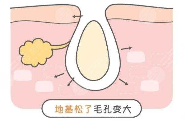 怎么收縮面部毛孔有又快速？文中3中方法你得學(xué)起來！如何預(yù)防是關(guān)鍵！