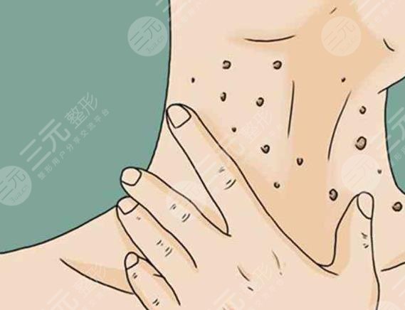 脖子上長(zhǎng)痘