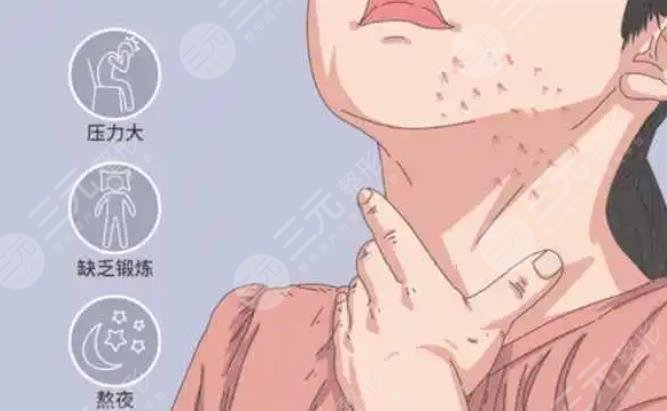 脖子上長(zhǎng)痘