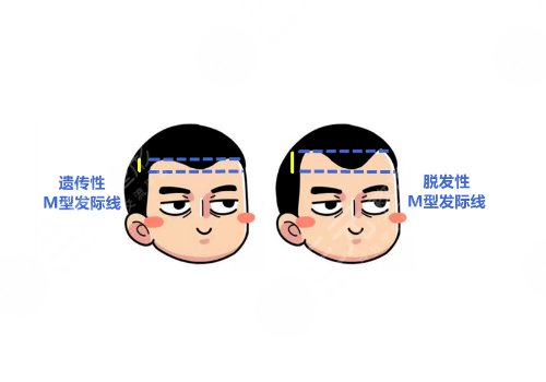 發(fā)際線高怎么挽救?