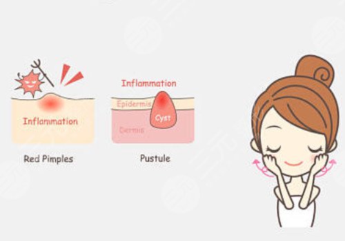 嘴角長痘痘是什么原因導致的？