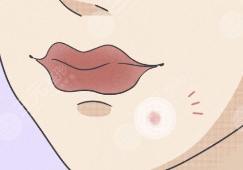 嘴角長痘痘是什么原因導致的？