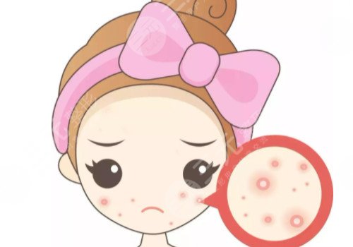 嘴角長痘痘是什么原因導致的？