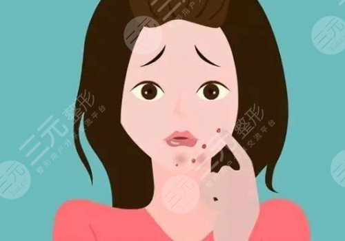 嘴角長痘痘是什么原因導致的？
