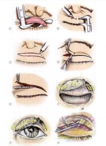 深圳藝星黃海俠醫(yī)生雙眼皮整形案例