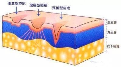 激光祛痘能去掉嗎?