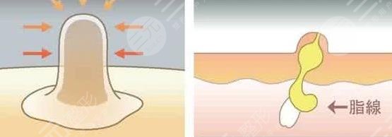 眼睛周?chē)L(zhǎng)脂肪粒怎么辦?