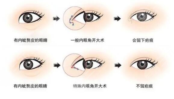 開內(nèi)眼角手術(shù)價(jià)格