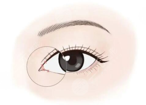 開內(nèi)眼角會(huì)回縮成以前嗎?