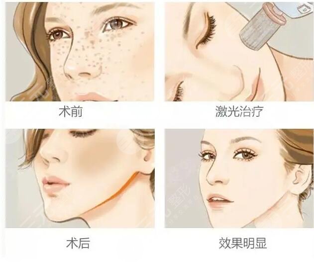 光子嫩膚