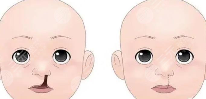 唇腭裂