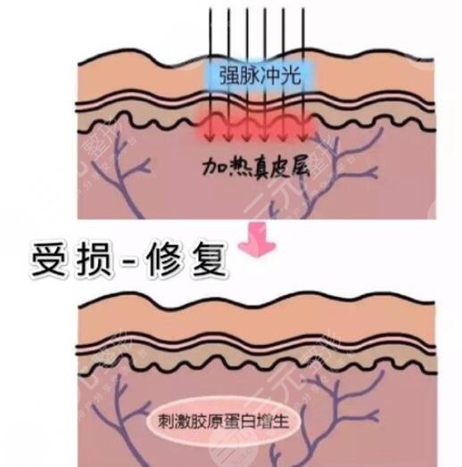 復(fù)合彩光去紅血絲果如何?