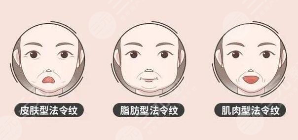 法令紋手術價錢一般多少錢？