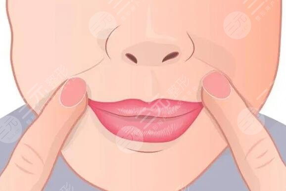 法令紋手術果如何？