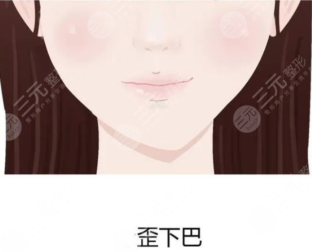 膨體隆下巴的術后護理