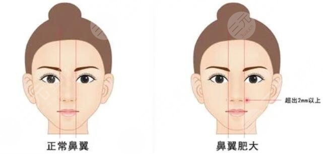 縮小鼻翼有哪些優(yōu)勢？