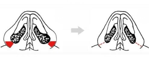 鼻翼縮小后需要注意什么？