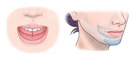 隆下巴假體恢復(fù)過程圖整理！隆下巴的手術(shù)過程是怎樣的？注意事項有哪些？