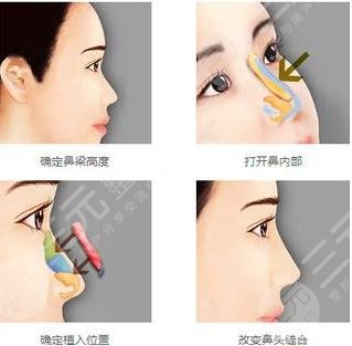 廈門(mén)大學(xué)附屬第一醫(yī)院整形美容科特色熱門(mén)項(xiàng)目：隆鼻