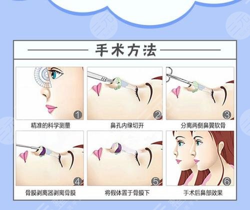 廈門(mén)大學(xué)附屬第一醫(yī)院整形美容科特色熱門(mén)項(xiàng)目：隆鼻