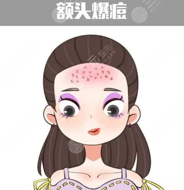 　　額頭上長痘痘的原因是什么呢?長痘痘是很多朋友的心頭大患，因為在進入青春期之后，很多朋友臉上都會或多或少的長出痘痘，痘痘又紅又腫，有的時候還有很多分泌物，一碰就很疼，這給大家?guī)砹撕芏嗟臒?。而有一部分朋友即便是走出了青春期，臉上仍舊有很多的痘痘存在。尤其是額頭上的痘痘特別的嚴重。實際上不同的部位痘痘生長都是有原因的，下面就針對額頭上的痘痘，我們進行深入的分析。  　　1、額頭上長痘痘的原因是什么?  　　痘痘又被大家稱作為痤瘡或者青春痘。一般在額頭上，臉上，胸部背部長得比較多。因為這些部位皮膚角質層比較薄，而且油脂分泌旺盛，給痘痘的生長提供了很好的條件。痘痘的生長是由于皮膚里面生產了大量的油脂，將毛孔堵塞。尤其是油脂栓塞了毛囊口加上周圍致痘細菌的影響，就形成了丘疹痘痘。這些痘痘一般呈現出紅色，用手輕輕擠壓就會擠出黑色的乳狀或者是乳白色的脂栓。  　　因為痘痘生長的位置比較靠近皮膚較深的部位，所以這些痘痘與周圍組織有緊密的聯系。如果痘痘變得過于的大或者過于深，很容易引起炎癥。有時痘痘生長以后不容易干癟脫落，有形成暗瘡和痘坑痘印的風險。青春期生長痘痘的幾率比較大。因為青春期的時候，人體內分泌容易紊亂，雌性激素和雄性激素分泌的情況會發(fā)生變化，所以就很容易生長痘痘。  　　2、去除痘痘的方法  　　去除痘痘要內外兼治，首先要調節(jié)飲食。少吃辛辣的食物，不吃油膩的食物，對于膨化食品也要少吃。這些食物有很大的刺激性，對于身體來講容易產生消化負擔，而且容易堆積垃圾，產生毒素。多吃維生素含量高的食物與水果，調節(jié)脾胃功能，促進腸胃蠕動，可以加快毒素的排出。  　　如果身體里有內分泌紊亂的現象，可以吃藥物調節(jié)。目前比較多的是四環(huán)素多，西環(huán)素米諾環(huán)素等這些藥物。可以使皮膚的脂肪酸濃度下降，抑制丙酸痤瘡菌的活性使青春痘生長喪失溫床。適當的運動。運動的時候身體產生大量的熱量。毛孔也會打開釋放熱能。隨著大量汗液的流出，也會有很多垃圾和油脂被排出體外給皮膚做深層潔面。  　　痘痘生長的過程中，不要用手去擠壓或者觸碰，可以涂抹消腫藥膏。蘆薈膠、祛痘膏都可以涂抹。避免因為錯誤的方法把痘痘變得紅腫，干癢產生炎癥，留下痘坑痘印兒。當痘痘生長過于密集的時候，可以采用鐳射激光，光子嫩膚，二氧化碳，點陣激光等方式來緩解痘痘。  　　3、額頭上長痘痘的案例介紹  　　青春期之后我的額頭開始長痘痘，有很多人告訴我，青春期過后痘痘就會消除，可是我千辛萬苦等到青春期結束直到二十幾歲，額頭上的痘痘一直沒有停止過生長，后來去看醫(yī)生，醫(yī)生說額頭上的痘痘映射了新陳代謝不好的問題。建議我可以嘗試一下內服藥物調理內分泌系統(tǒng)。于是我就在醫(yī)生的建議下，吃了大概三個月的中藥。  　　中藥的主要作用就是舒筋活絡，加速代謝，排解垃圾。自從吃了中藥以后，我感覺自己整個身體經營了很多，很多之前會有習慣性的便秘，但是慢慢的身體的消化系統(tǒng)舒適了，不再出現胃酸反胃便秘等這些問題。大概在吃藥后的一個月再次來月經的時候，臉上并沒有長出原來那么多痘痘，只是少許的幾顆，這讓我看到了曙光，于是連續(xù)吃了三個月，現在基本調理好了。