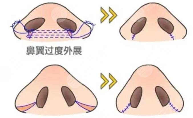 鼻頭整形