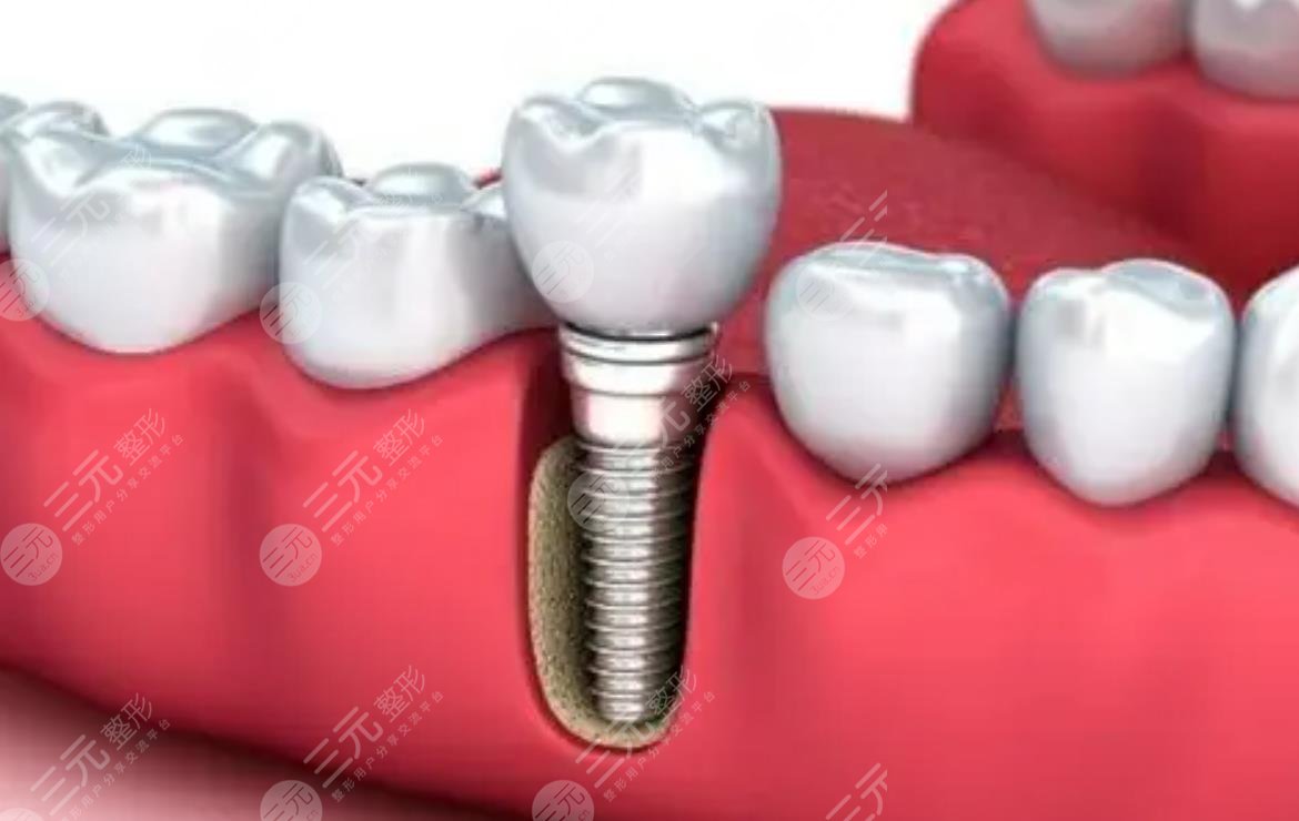 種植牙