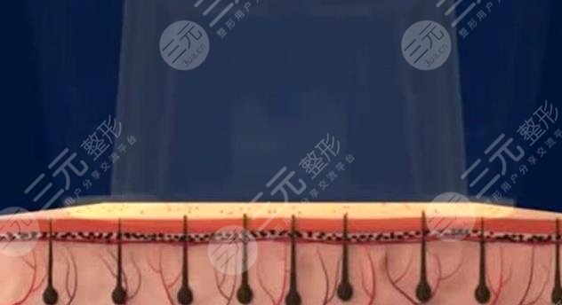 脫毛