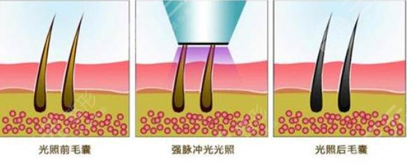 脫毛
