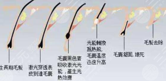 脫毛