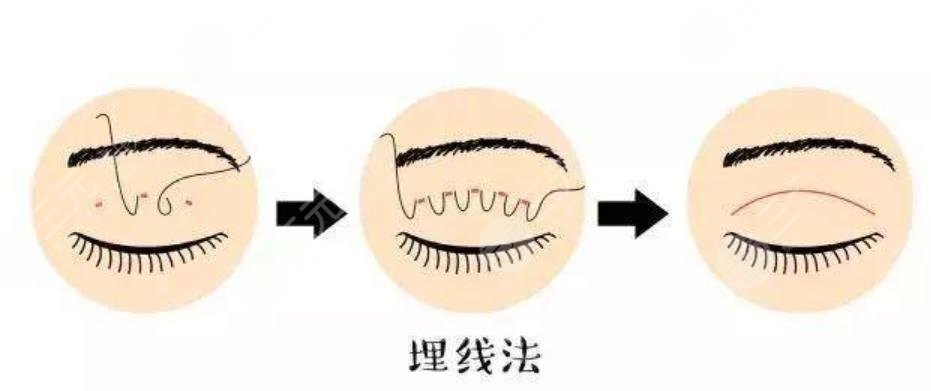 雙眼皮