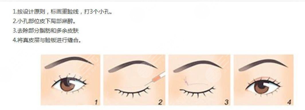 雙眼皮