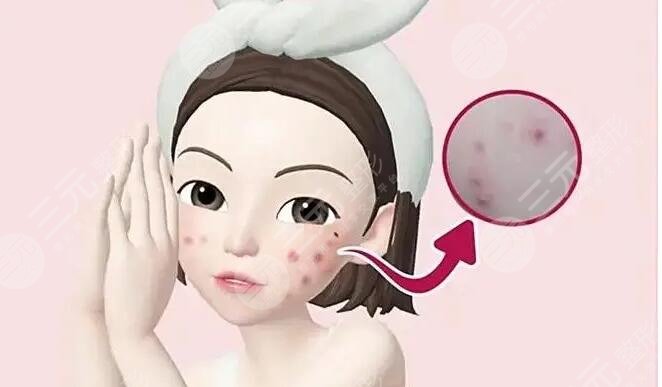 痤瘡疤痕怎么治才能徹底？這幾種有方法網(wǎng)友們親測果，給你更好選擇~
