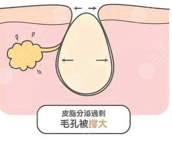 什么醫(yī)美項(xiàng)目收縮毛孔果好？近幾年爆款醫(yī)美項(xiàng)目云集，總有一款適合你~
