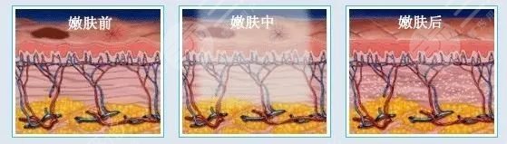 怎樣去除抬頭紋和魚尾紋?