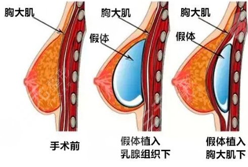 隆胸假體可以放一輩子嗎?
