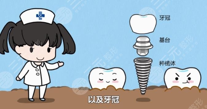 牙齒種植