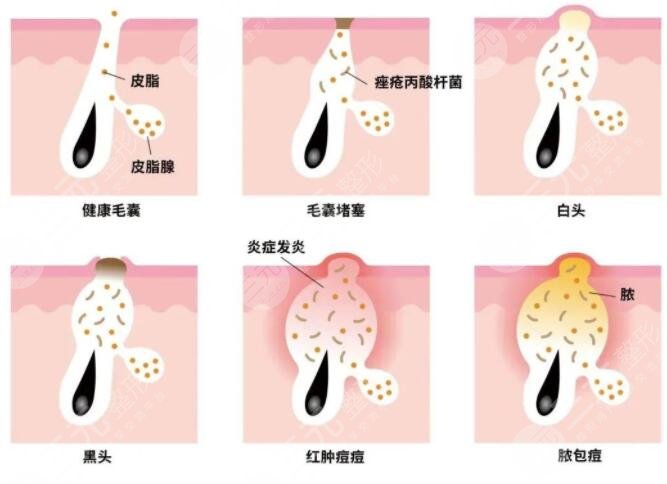 復合彩光祛痘需要多少錢?